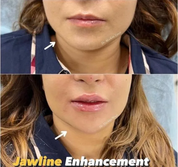 Before and after jawline enhancement result