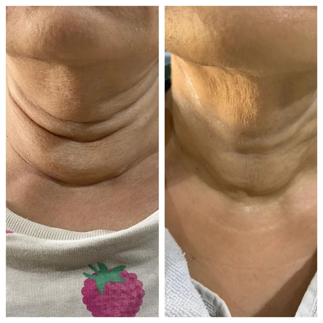Before and after neck rejuvenation treatment result