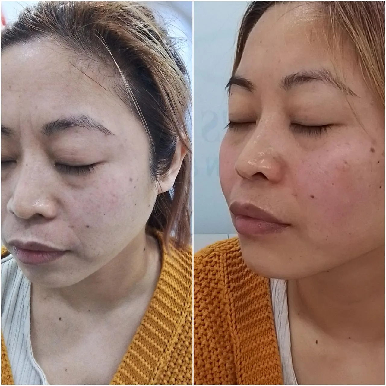 Before and after facial skin rejuvenation result
